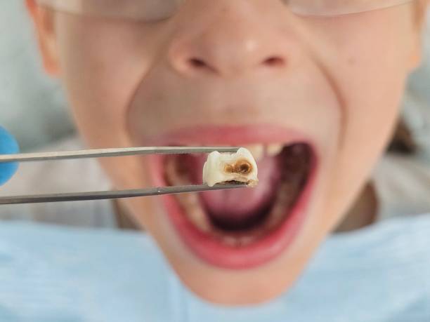 Best Emergency Tooth Extraction in Canton Valley, CT